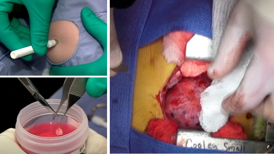 Full cycle extracting cells from patients body